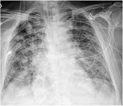 Pediatric Chest X-ray Pneumonia Detection